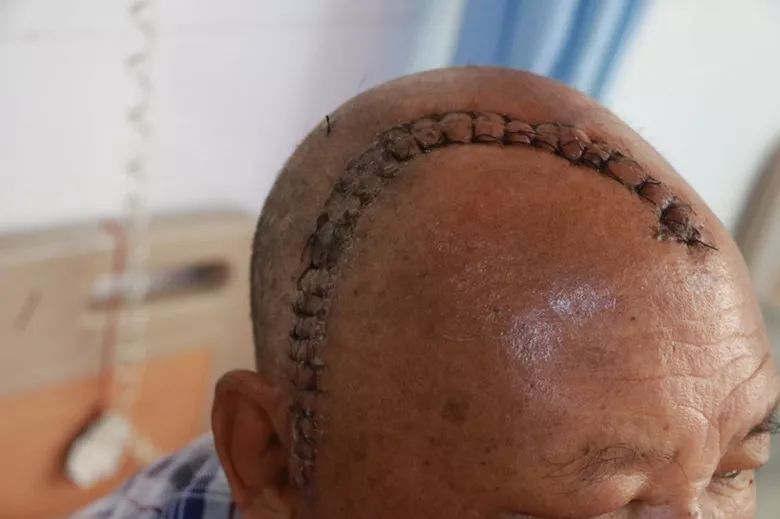 区人民医院成功切除颅底巨大脑膜瘤七旬老人重获新生