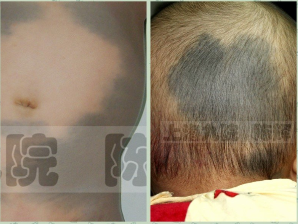 蒙古斑:多发生于新生儿的腰骶部,偶见于背部,蒙古斑多表现为圆形或卵