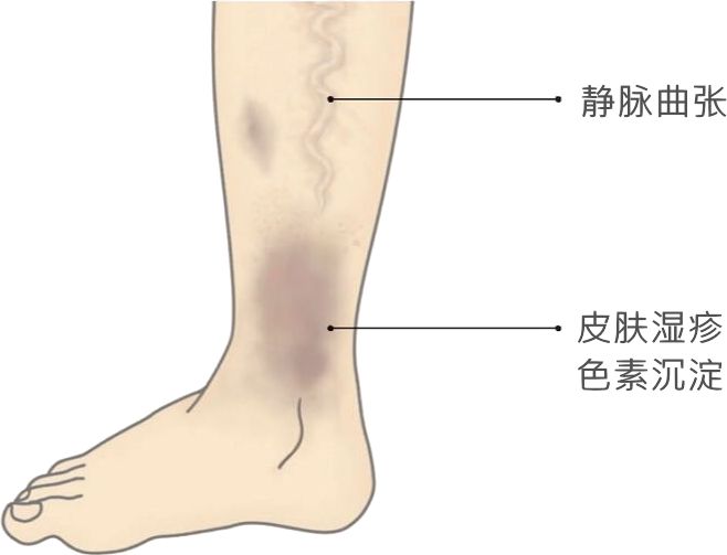 大隐静脉曲张分级图片