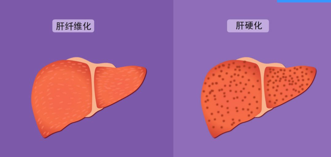 肝纖維化和肝硬化有什麼區別