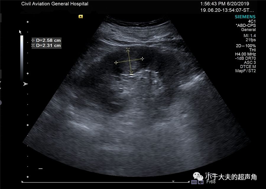 肾癌超声图片