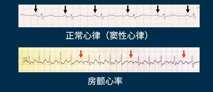 室颤和房颤图片