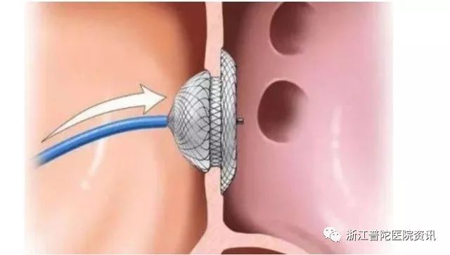 多年心病一朝除全市首例自主房间隔缺损封堵术在普陀医院圆满完成