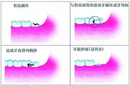 智齒髮炎您該重視