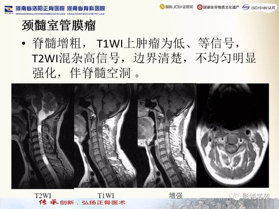 经典椎管内常见肿瘤mr诊断