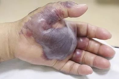 但无论如何,我们似乎都会使人体爆发脓毒症,引起发热,寒战,休克,典型