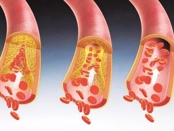 血管堵塞百病生早预防好治疗
