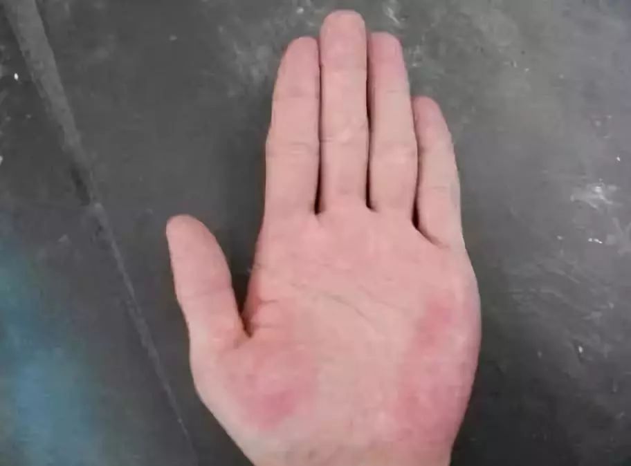 肝脏好的人,手上通常有4个"标志",来看看,你有几个?