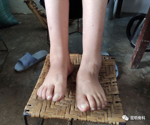 圆梦昆骨临沧马蹄足女孩终于像常人一样走路