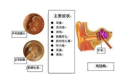 中耳炎最佳治疗方法图片