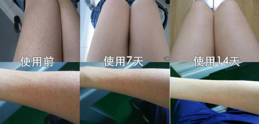 鸡皮疙瘩胳肢窝怎么去除(胳肢窝有鸡皮疙瘩是怎么回事)