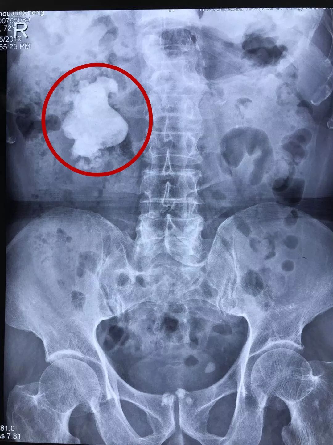 除了右肾的这枚巨大肾结石外,患者的左肾和输尿管还有两枚小的结石