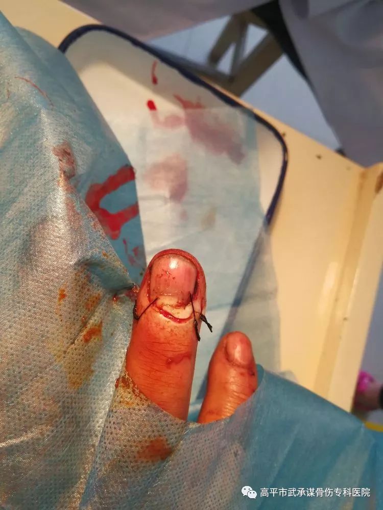 经常碰到许多手指,足趾挤压伤,先给予拍x线片,采用神经阻滞麻醉,麻醉