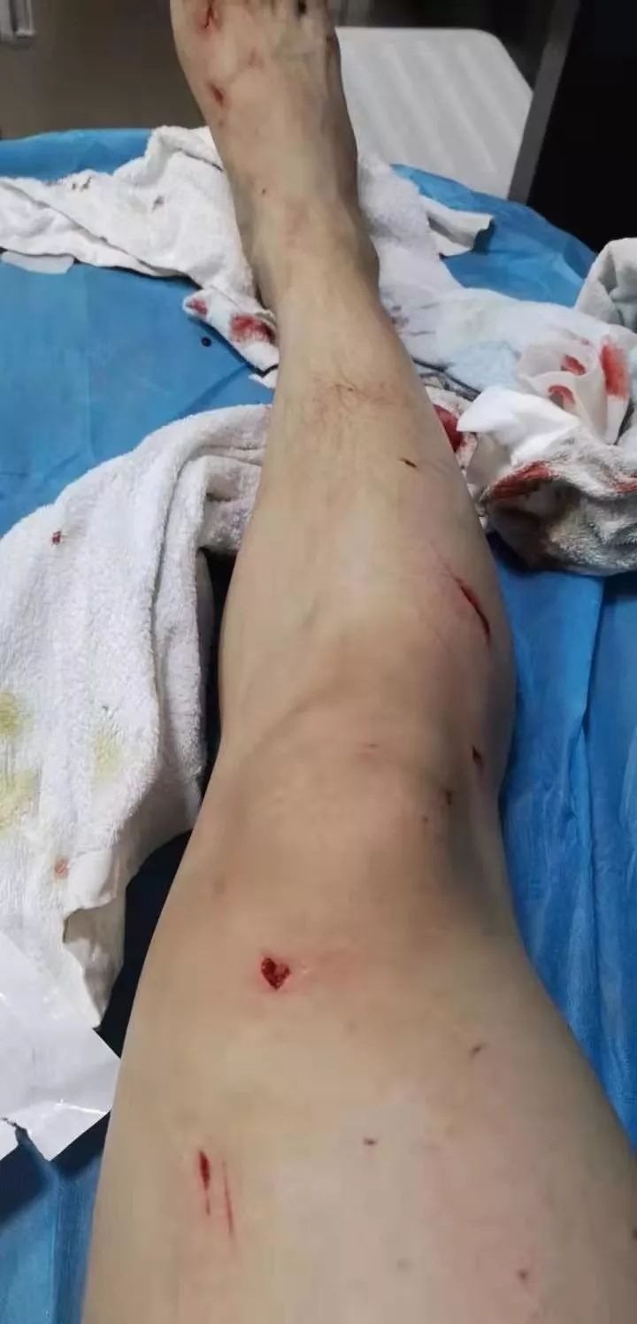 有7处伤口比较大,还缝了针练先生全身被玻璃炸伤了50多处玻璃碎了一地