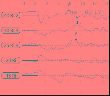 小耳畸形患者听力解决方案