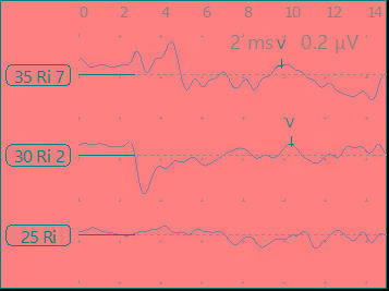 小耳畸形患者听力解决方案
