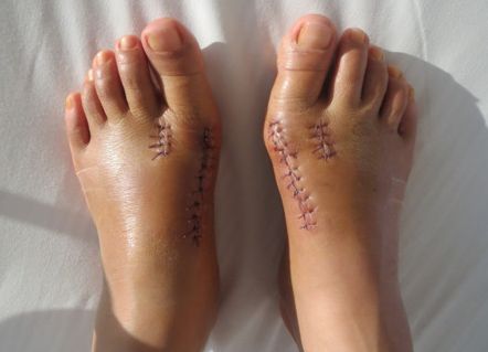 穿高跟鞋≠得拇外翻,关于拇外翻的全面解答,你值得拥有!_畸形