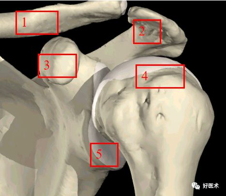 5. 關節盂4. 肱骨頭3. 喙突2. 肩峰1.
