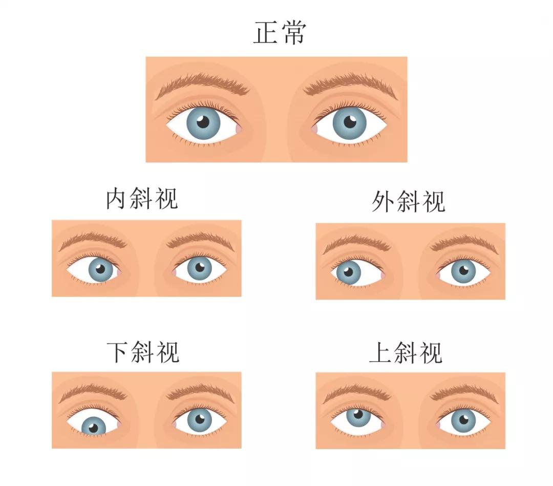 如何避免儿童斜视发展成弱视 四个 O 了解一下 治疗