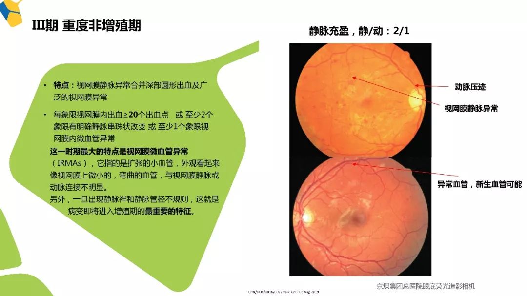 多年来倡导的多学科合作,现在糖网病有了明确章程!