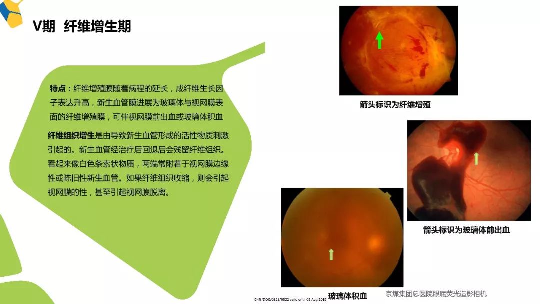多年来倡导的多学科合作,现在糖网病有了明确章程!