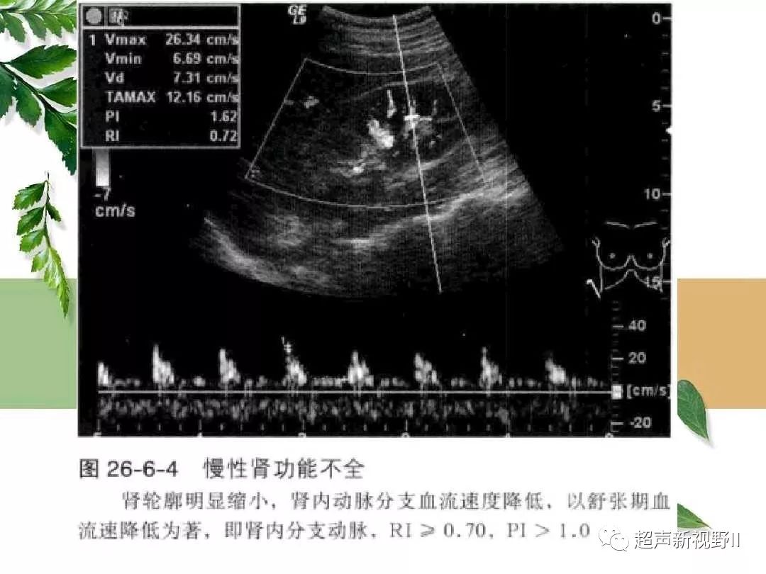 肾实质损害与肾衰竭超声诊断