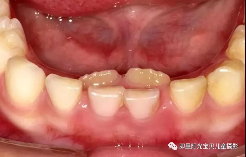 孩子换牙时一定不能吃硬物小心双排牙