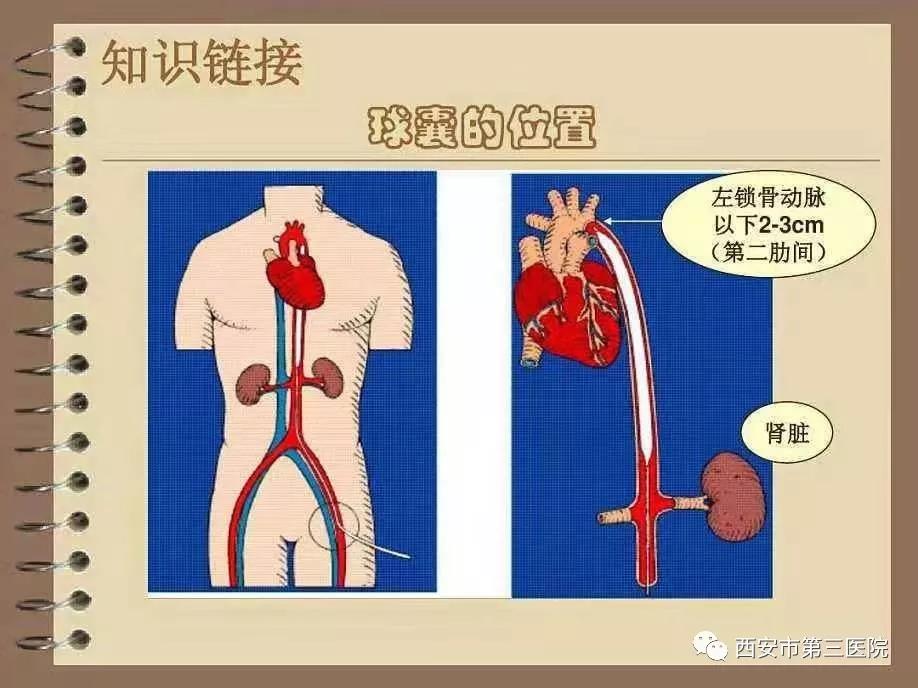 【搏动生命的奇迹】市三院心胸外科成功开展主动脉球囊反搏术