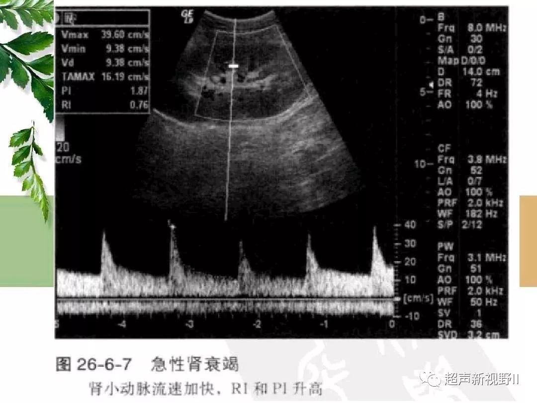 肾实质损害与肾衰竭超声诊断