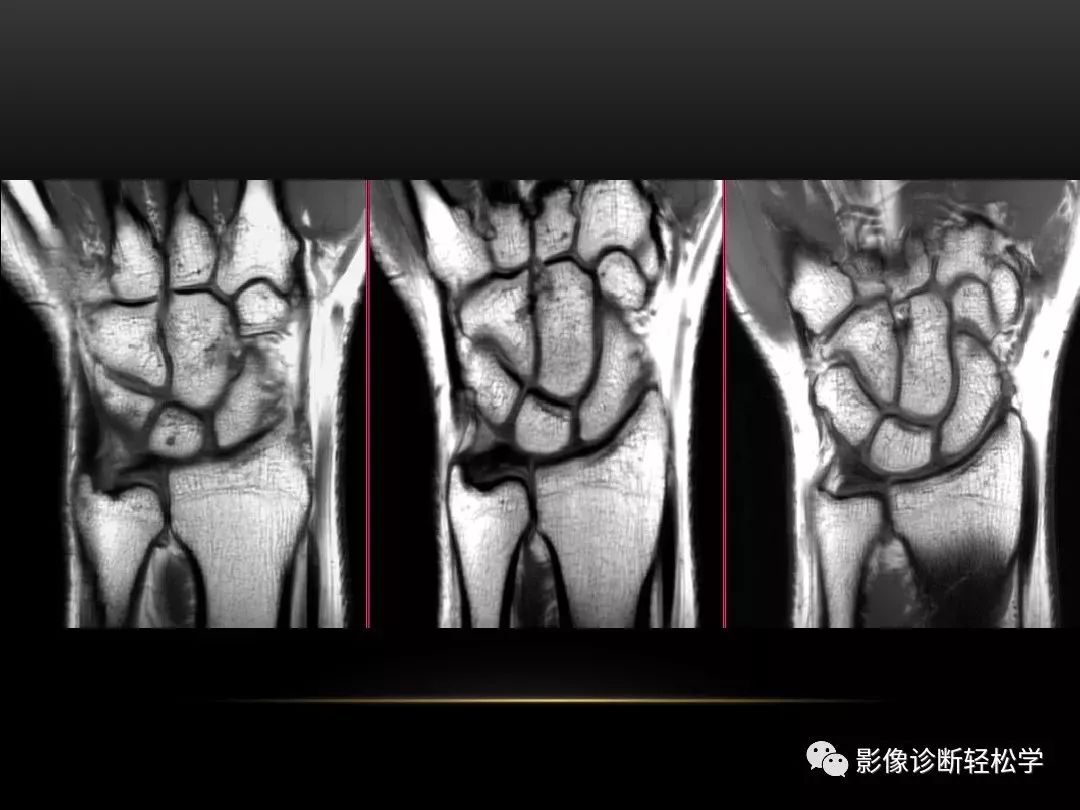 腕关节病变的mri诊断和解剖