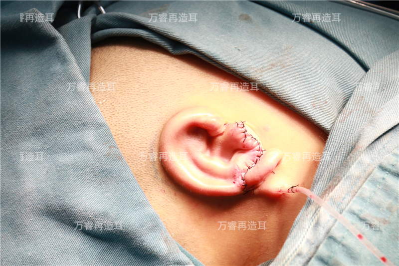 万睿医生丨再造耳的核心技术有哪些