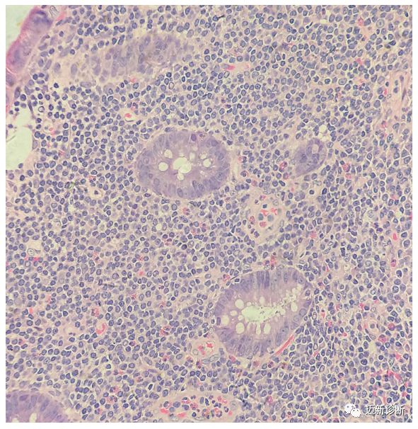 8例肠黏膜相关淋巴组织淋巴瘤的临床病理特征