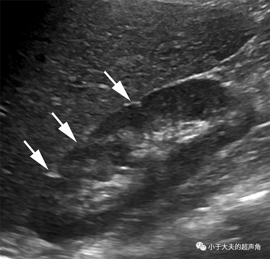 長箭所示△高回聲,即永存胚胎期分葉狀腎那未完全融合的腎皮質.