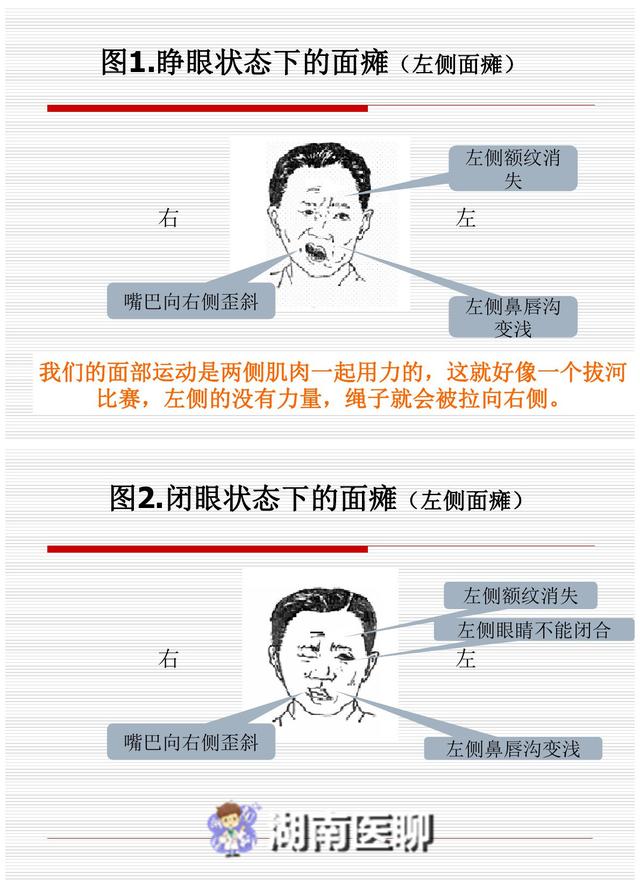 怎样判断小儿面瘫图片图片