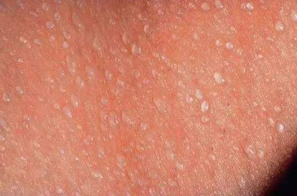 常见的痱子类型可以根据汗腺堵塞的深度,具体分为晶痱,红痱,脓痱,深痱