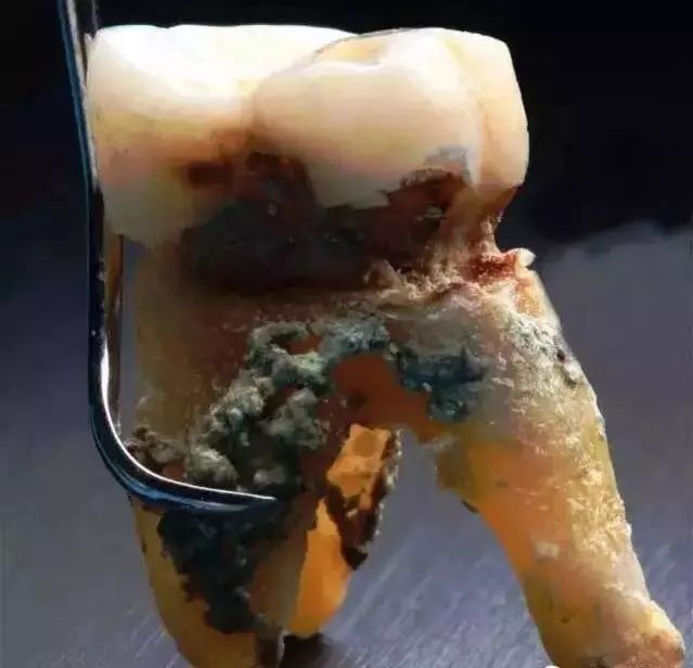 在患者不知情的时候,整颗大牙都被牙结石腐蚀掉了.