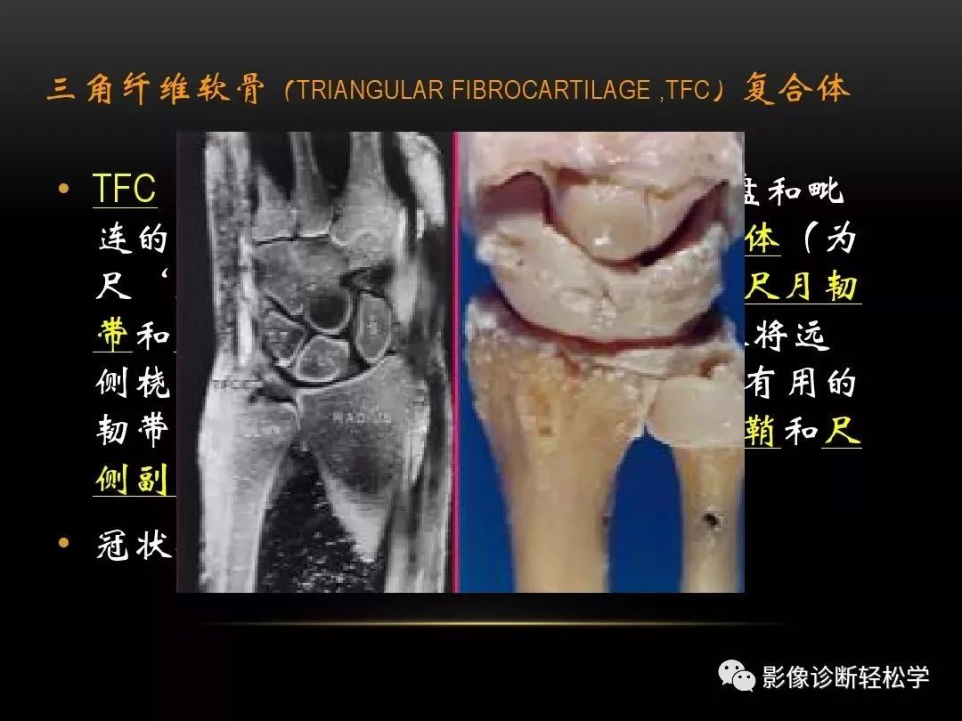 腕關節病變的mri診斷和解剖