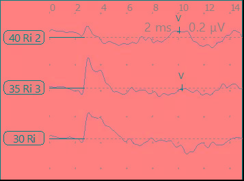 小耳畸形患者听力解决方案