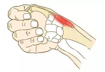 產後手腕痠疼沒勁兒可能得了腱鞘炎了