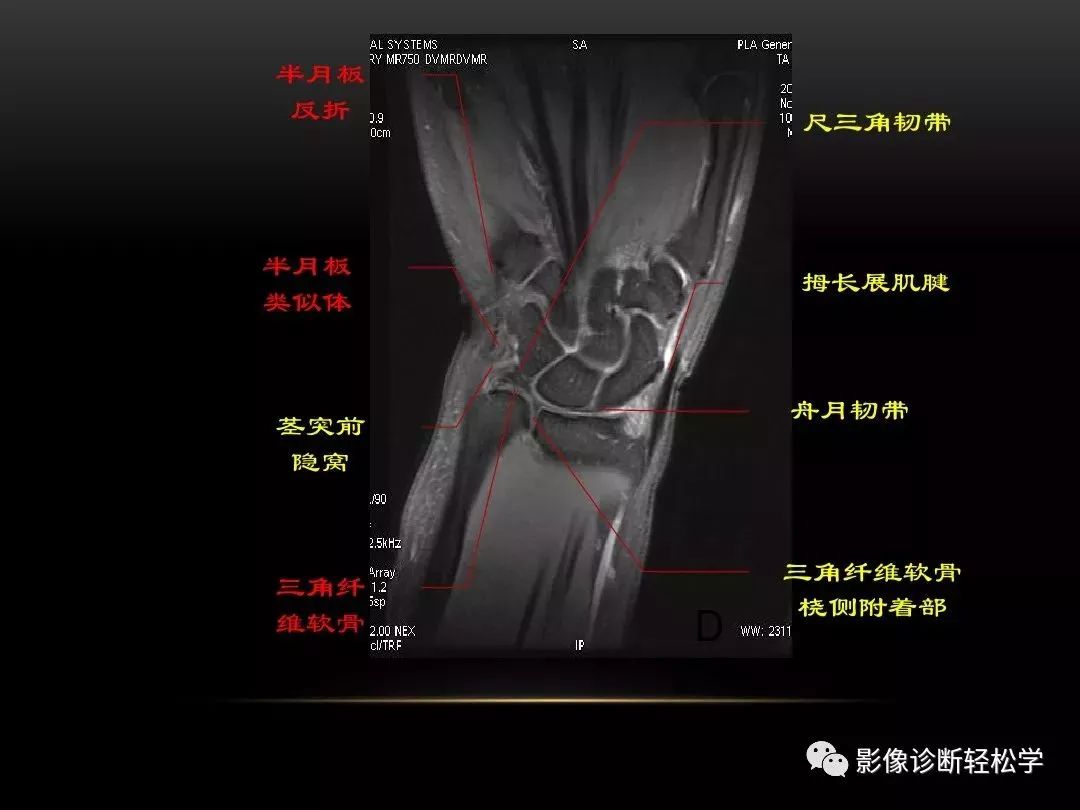 腕关节横断面解剖图图片