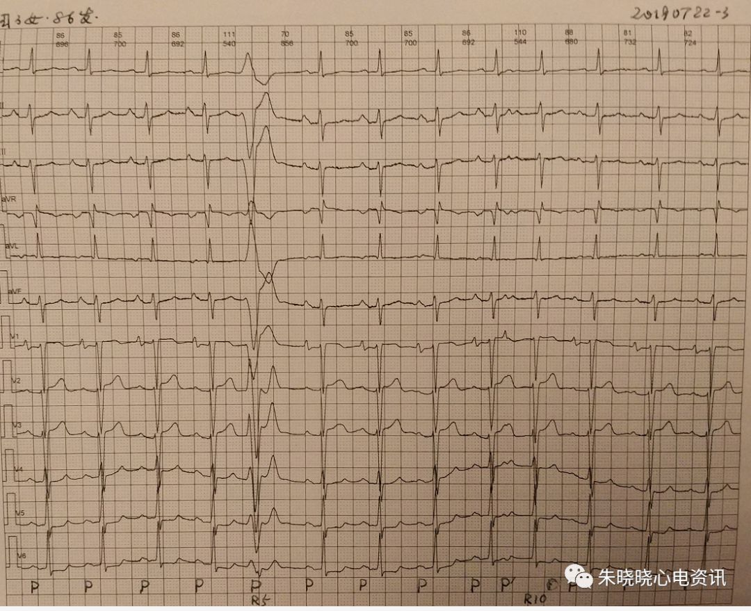 卢老师看心电图先后发生的房性早搏与室性早搏伴房室绝对干扰2019718