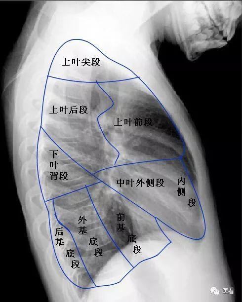 肺炎胸片图解图片