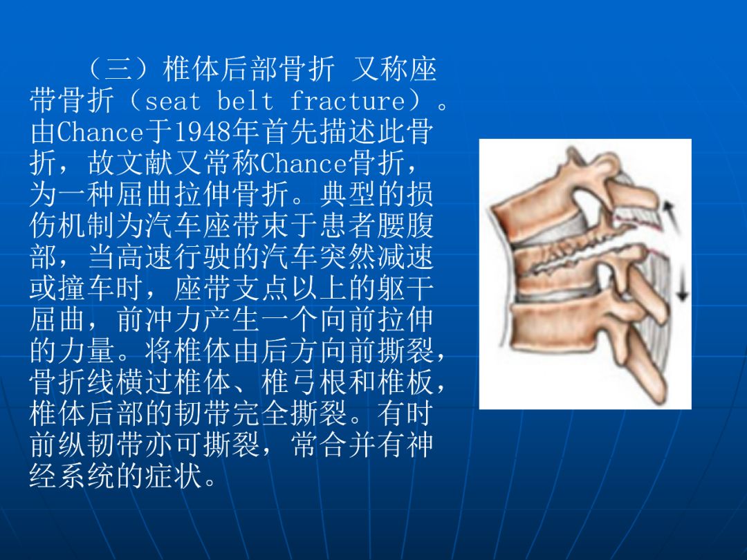 3 牽拉屈曲型(distractive flexion) 脊柱在屈曲位受傷,在安全帶型的