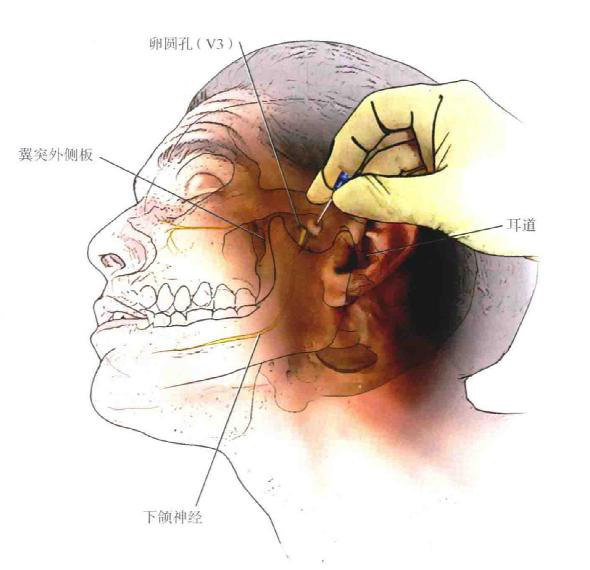 疼痛科運用神經穿刺術治癒嚴重頭面部帶狀皰疹後神經痛患者