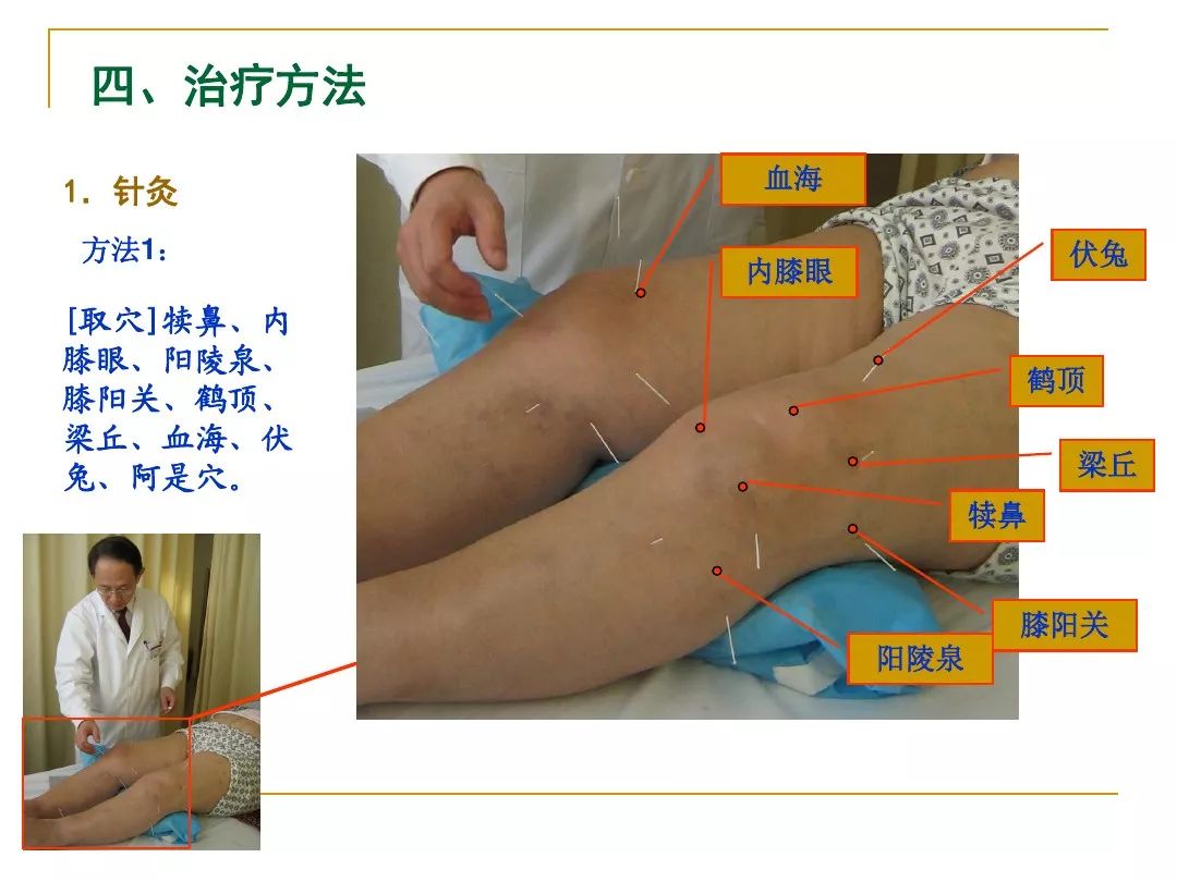 膝关节骨性关节炎的中医综合治疗