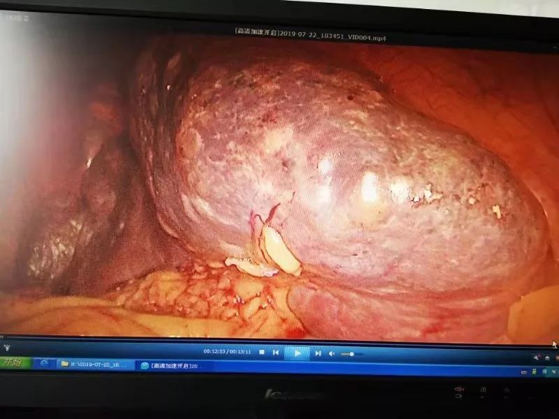 普外科三病区独立完成全院首例全腹腔镜下脾肿瘤切除术