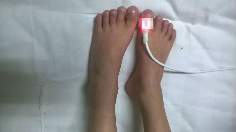 刚来医院时,妞妞的精神很差,呼吸急促,面色青紫,口周发绀,可见鼻翼扇