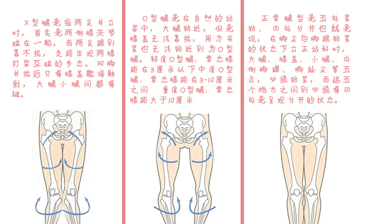 xo型腿是怎么形成的xo型腿该如何矫正