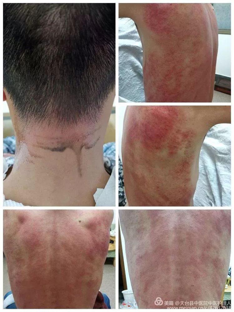 铜砭刮痧疗法县中医院砭治痛风有奇效