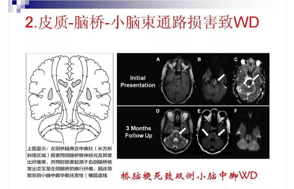 华勒氏变性图片